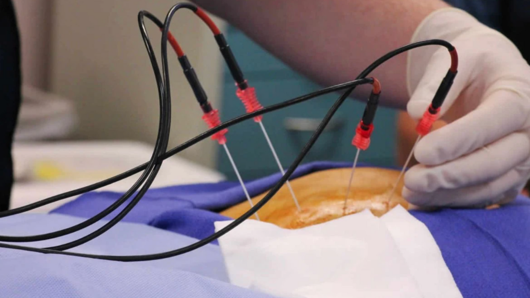 Radiofrequency-Ablation_-A-Minimally-Invasive-Solution-for-Chronic-Pain-1