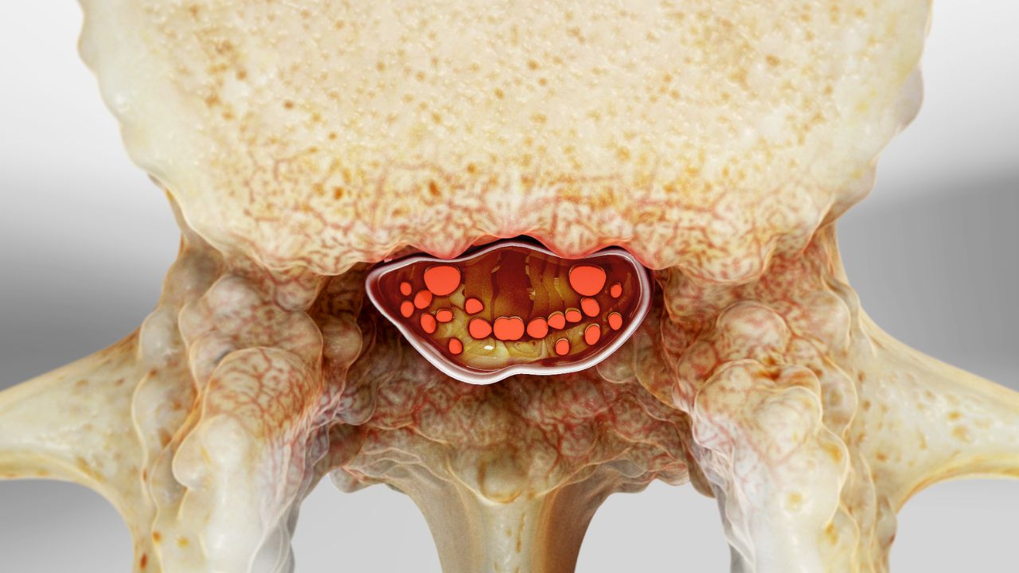 stenosis_1280